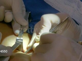Un j lee à partir de wwe obtient son third sein implant: gratuit adulte vidéo 8e
